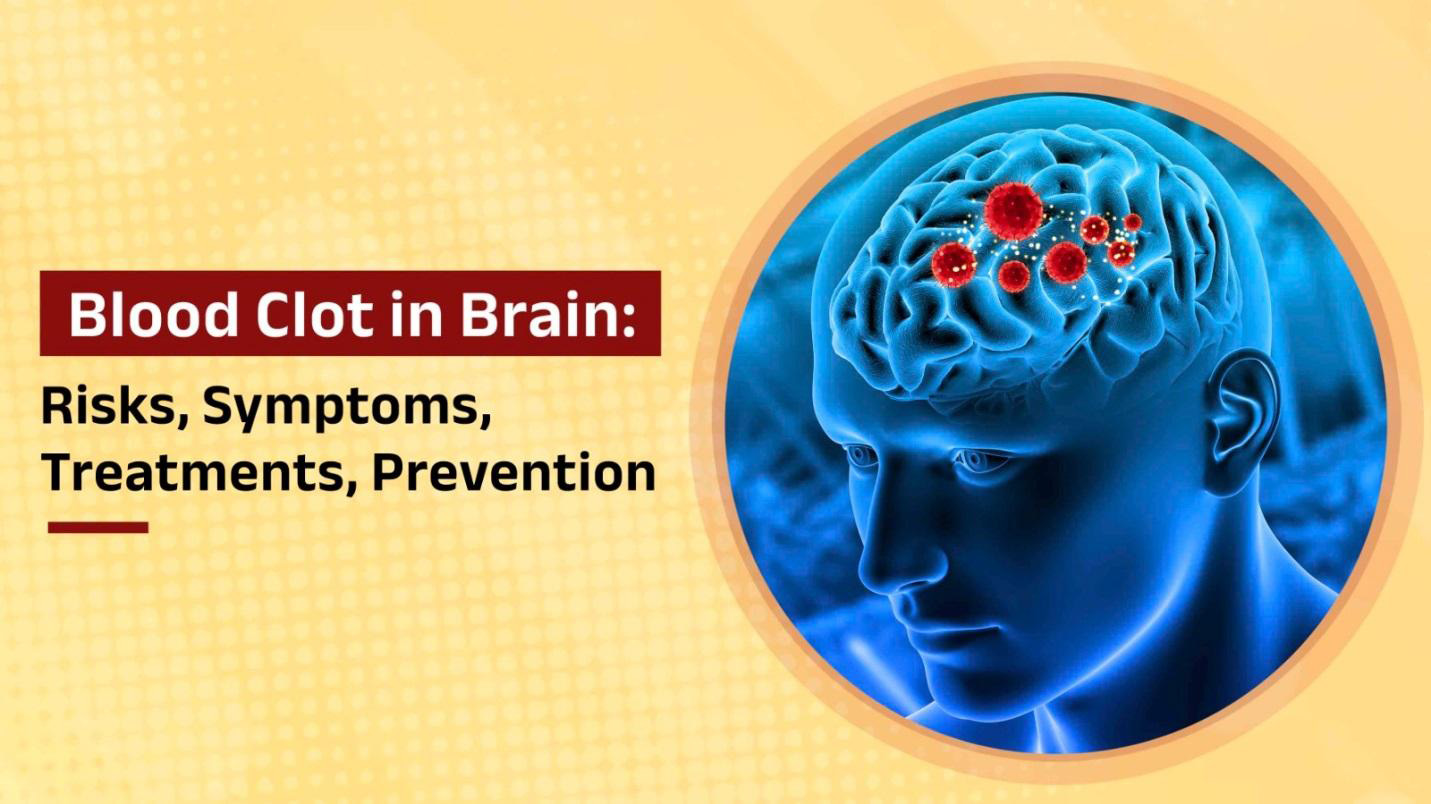 Blood Clot in Brain Risks, Symptoms, Treatments, and Prevention | DPU ...