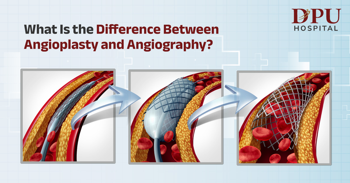 Angioplasty vs Angiographye